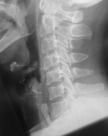 Swallowed Foreign Body | Image | Radiopaedia.org