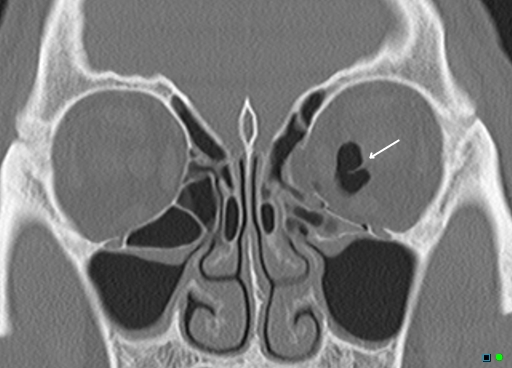 Isolated Medial Blow-out Orbital Fracture: Orbital And Blepharal ...