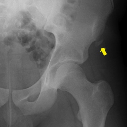 Anterior superior iliac spine avulsion | Radiology Case | Radiopaedia.org