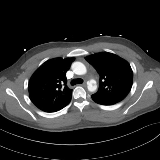 Aortic transection | Image | Radiopaedia.org