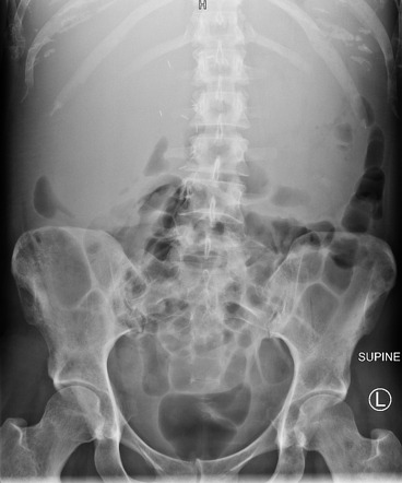 Hepatomegaly | Radiology Reference Article | Radiopaedia.org