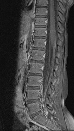 Guillain Barre Syndrome Radiology Case Radiopaedia Org