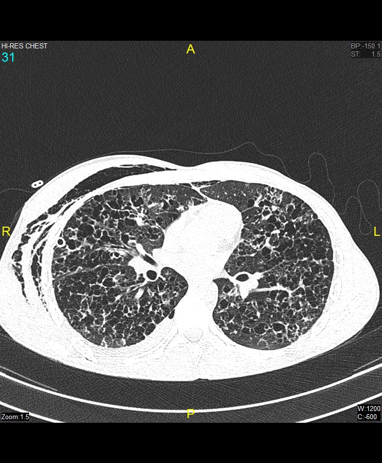 Pulmonary Langerhans Cell Histiocytosis Image