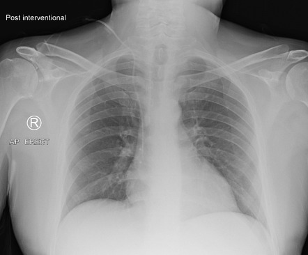 Central venous catheter on chest x-ray | Radiology Case | Radiopaedia.org