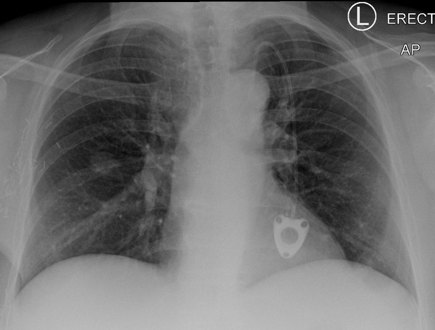 Coin lesion lung Radiology Reference Article Radiopaedia