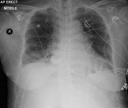 Viewing playlist: Enfisema Subcutaneo | Radiopaedia.org