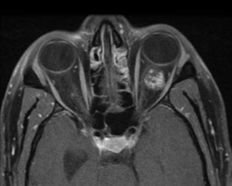 Мрт глаза. Кавернозная гемангиома орбиты на мрт.