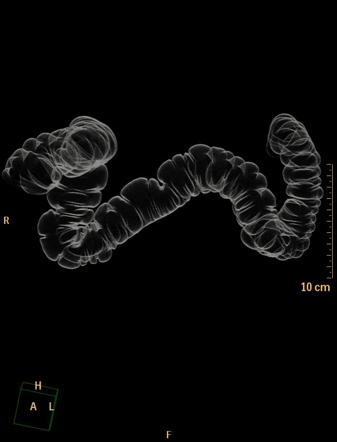 Computed Tomographic Ct Colonography Radiology Reference Article Radiopaedia Org