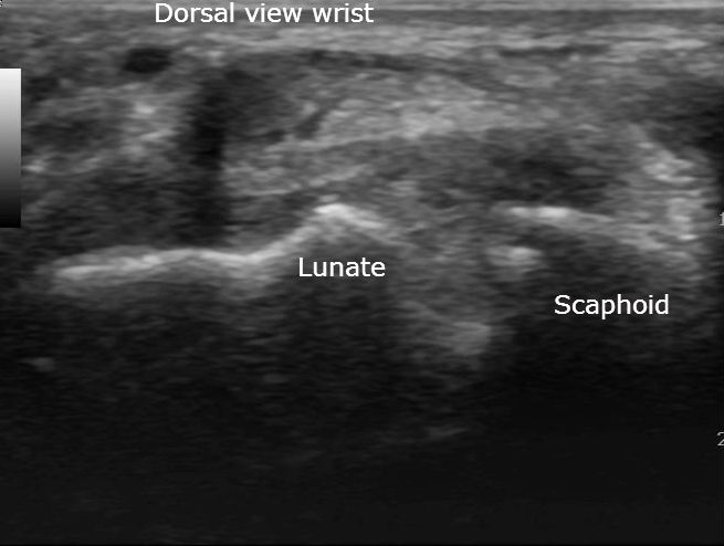 Scapholunate ganglia and lunotriquetral coalition | Image | Radiopaedia.org