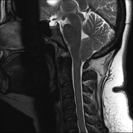 Chiari I malformation | Radiology Case | Radiopaedia.org