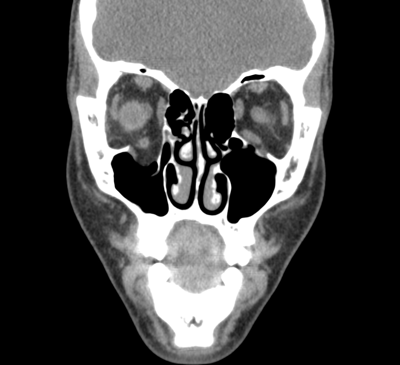 Orbital Blowout Fracture | Image | Radiopaedia.org