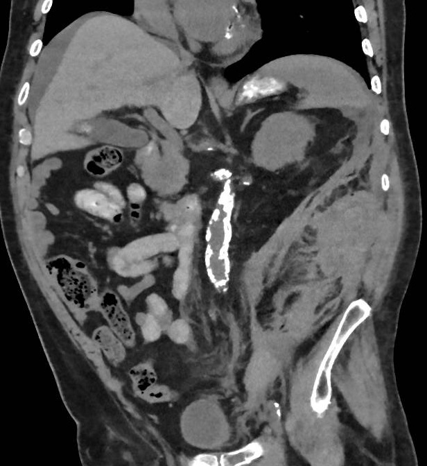 Retroperitoneal Hematoma Subcostal Artery Puncture Percutaneous