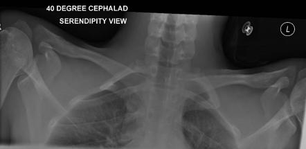 Sternoclavicular joint (serendipity view) | Radiology Reference Article ...