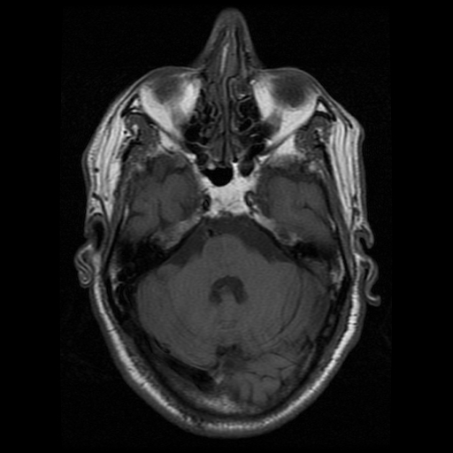 Inferior medial pontine (Foville) syndrome | Image | Radiopaedia.org