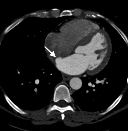 Interatrial septal aneurysm | Image | Radiopaedia.org