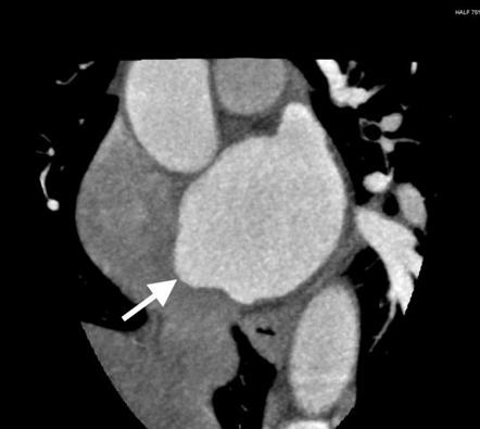 Interatrial septal aneurysm | Radiology Reference Article | Radiopaedia.org