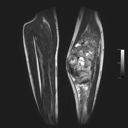 Fibromatosis of the calf | Image | Radiopaedia.org