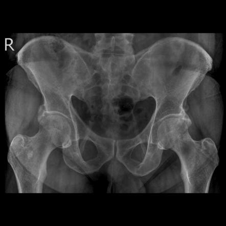 Ankylosing spondylitis | Radiology Reference Article | Radiopaedia.org