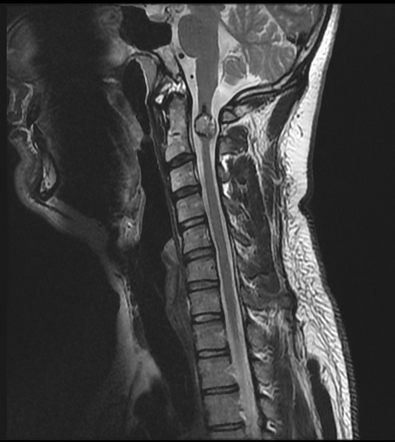 Cervical spinal cord cavernoma | Radiology Case | Radiopaedia.org