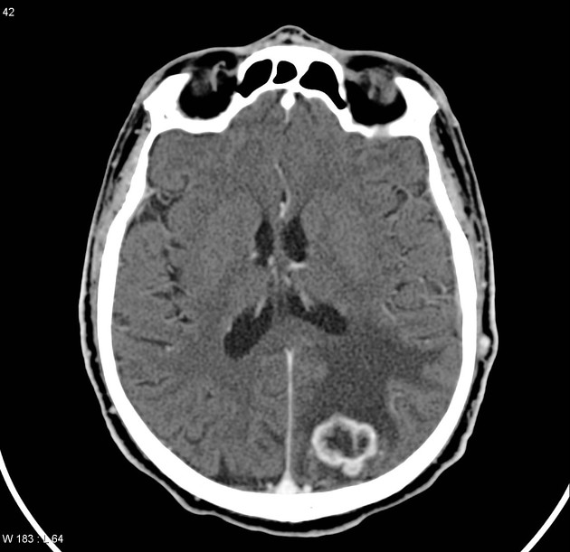 Metastatic renal cell carcinoma to brain | Radiology Case | Radiopaedia.org