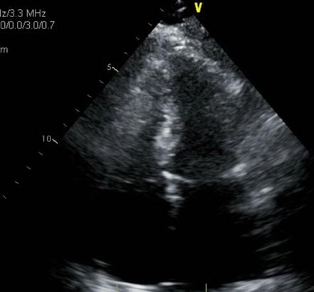 Takotsubo cardiomyopathy (echocardiography) | Image | Radiopaedia.org