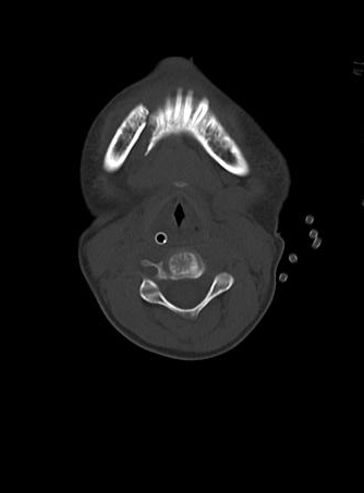 Mandibular fracture | Image | Radiopaedia.org