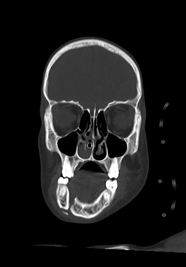 Mandibular fracture | Image | Radiopaedia.org