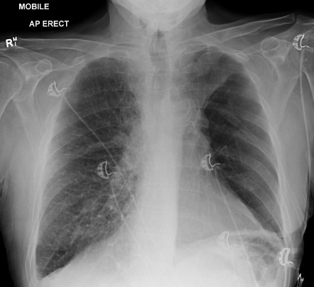 Lymphangitis carcinomatosis | Radiology Case | Radiopaedia.org