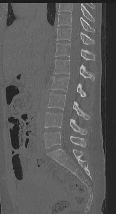 Thoracolumbar Injury Classification And Severity Score TLICS Radiology Reference Article