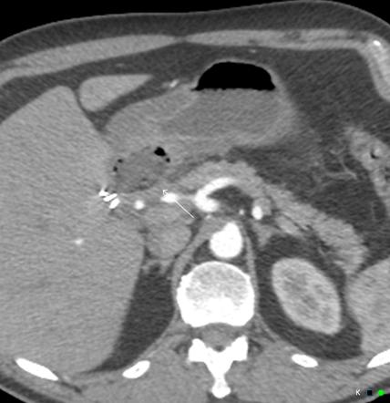 Peptic Ulcer Disease Radiology Reference Article Radiopaedia Org