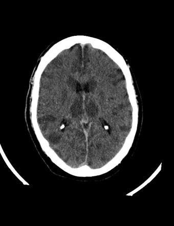 encephalopathy hypoxic ischemic radiopaedia