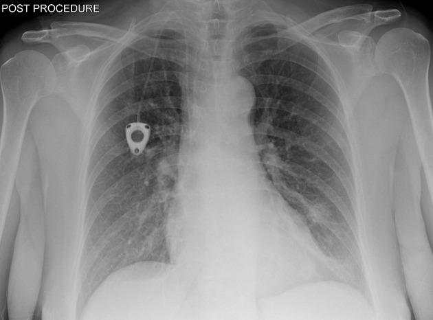 Coin lesion lung Radiology Reference Article Radiopaedia