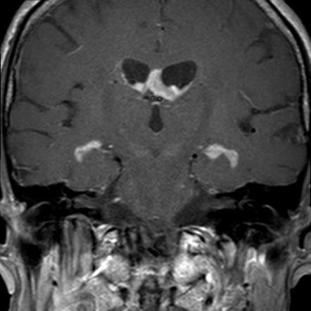 CNS Lymphoma | Radiology Case | Radiopaedia.org