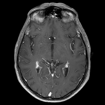 Lymphomas of the central nervous system | Radiology Reference Article ...