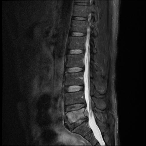 Tuberculous spondylitis | Image | Radiopaedia.org