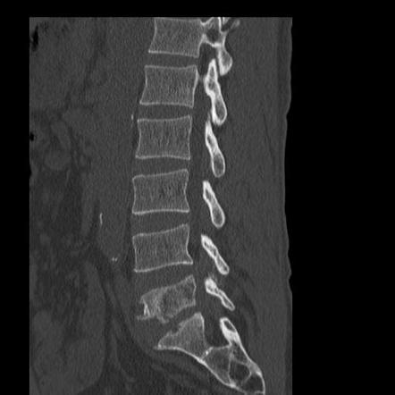 Tuberculous spondylitis | Radiology Case | Radiopaedia.org