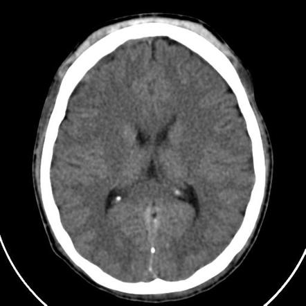 Subgaleal lipoma | Radiology Reference Article | Radiopaedia.org