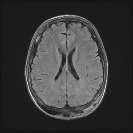 Subgaleal hematoma | Image | Radiopaedia.org