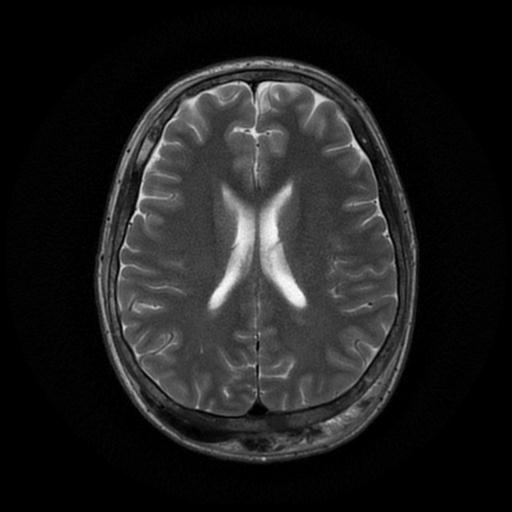 Subgaleal hematoma | Image | Radiopaedia.org