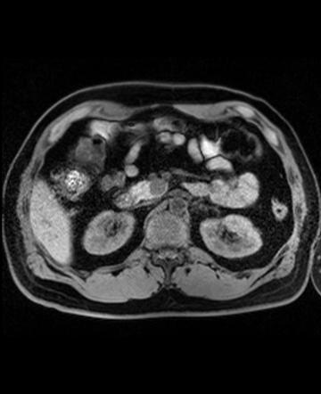 Insulinoma | Image | Radiopaedia.org