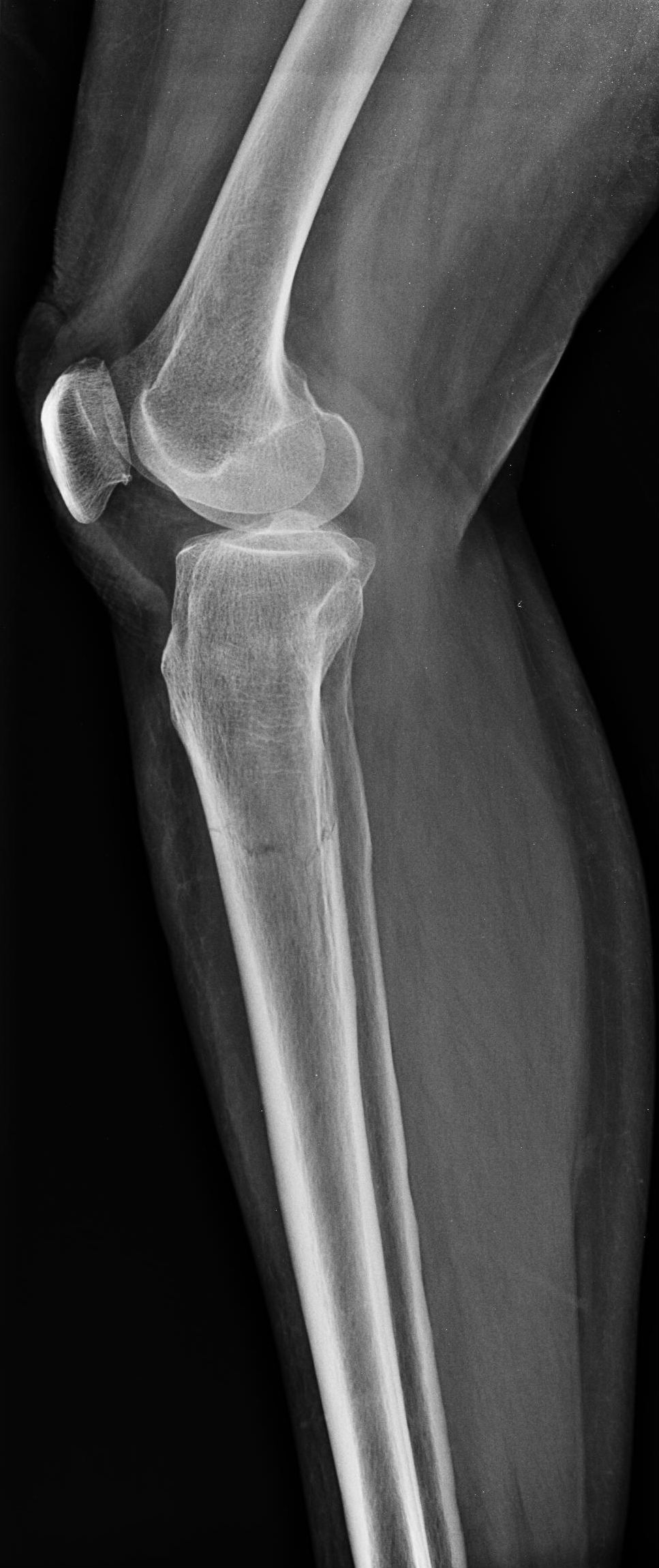 tibia fracture