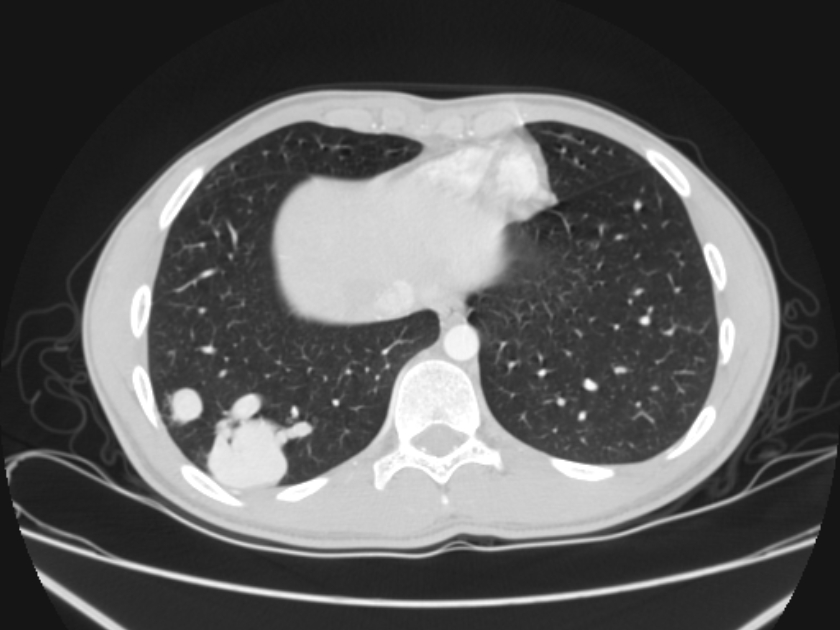 Osler-Weber-Rendu syndrome | Image | Radiopaedia.org