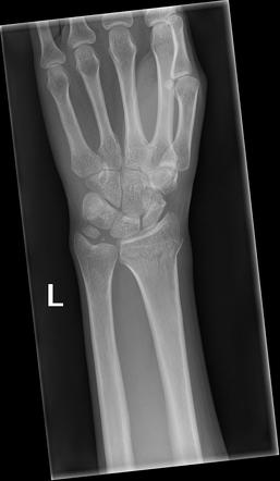 Rupture extensor policis longus | Radiology Case | Radiopaedia.org