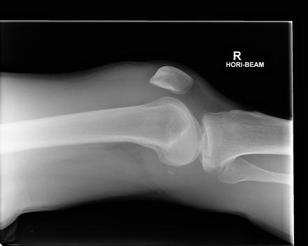 Posterior Cruciate Ligament Avulsion Fracture Radiology Reference Article Radiopaedia Org