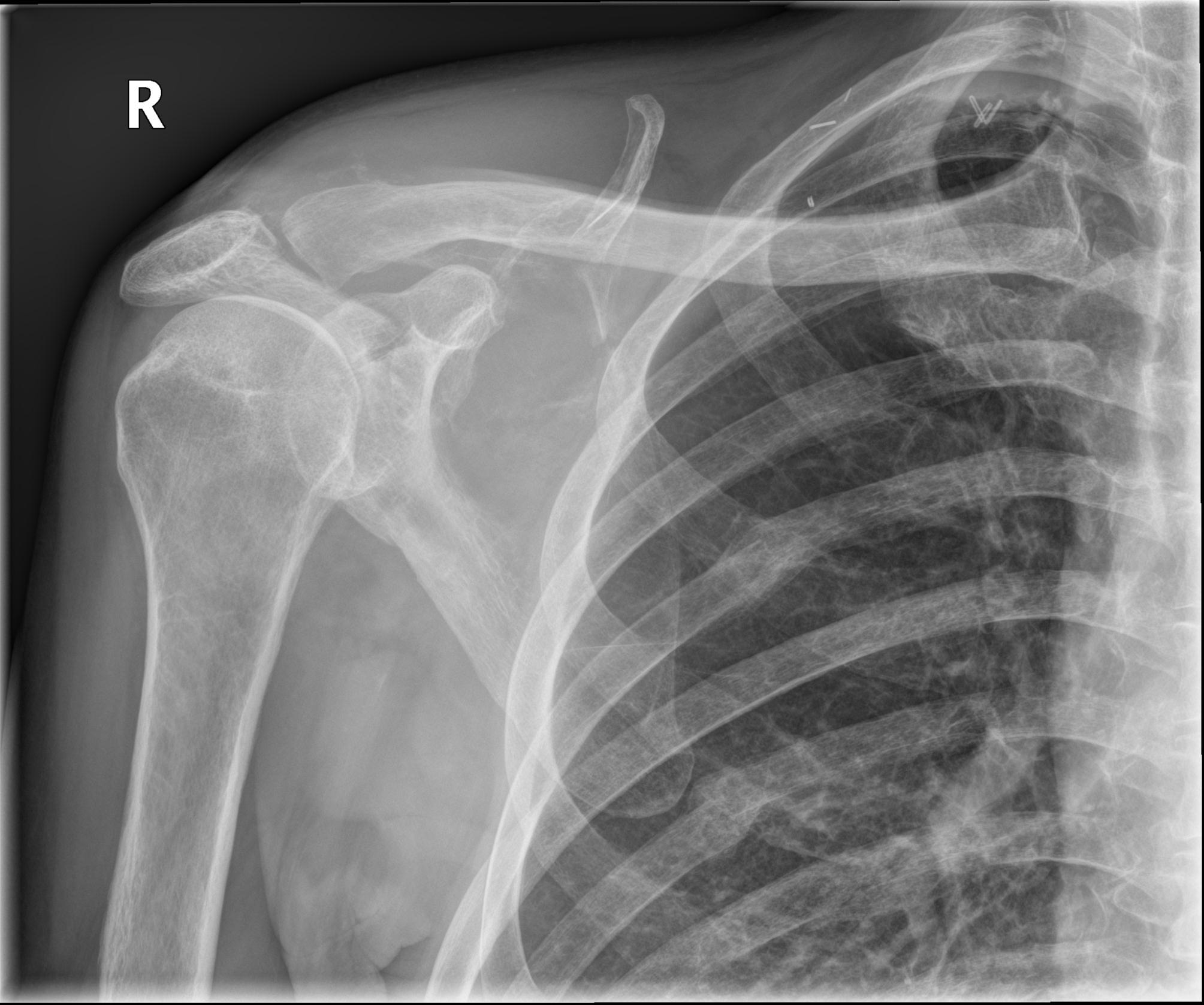 Bone metastasis from squamous cell carcinoma | Image | Radiopaedia.org