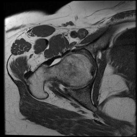 Bilateral Acetabular Protrusion With Pincer Type Femoro-acetabular 