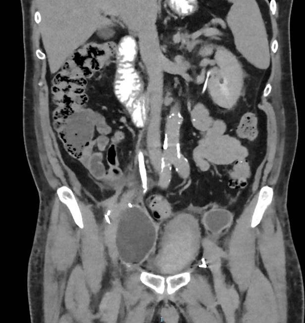 Infected lymphocele post radical prostatectomy | Image | Radiopaedia.org