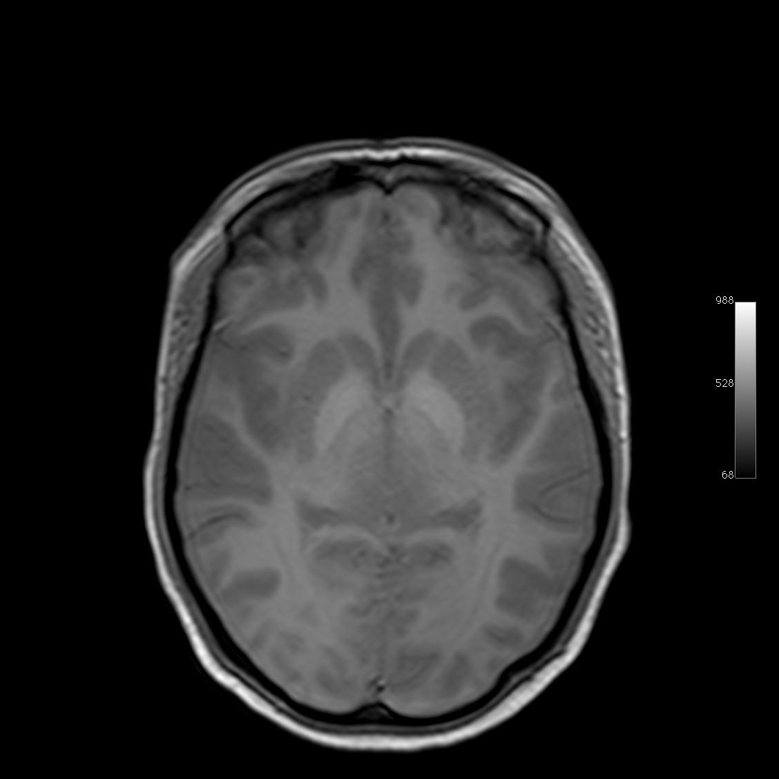 Global hypoxic ischemic encephalopathy - brain death | Image ...