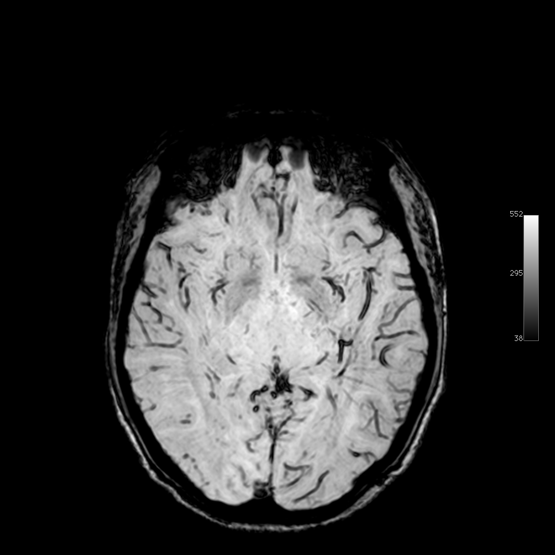 Мрт мозгов спб. Т1 gradient Echo MRI. Мрт после смерти мозга.