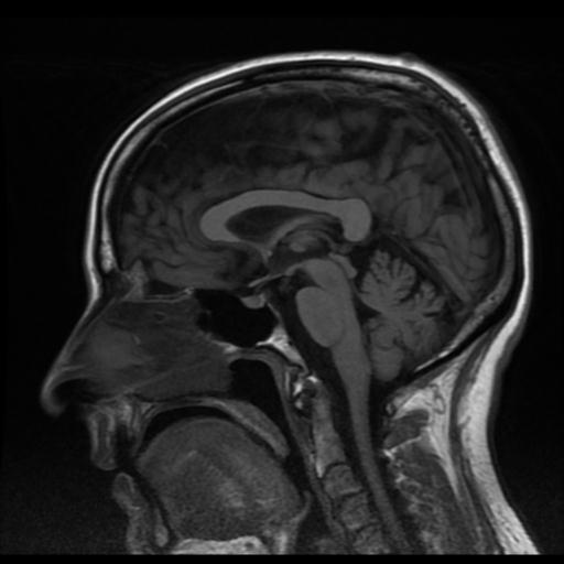 Frontotemporal dementia - language variant | Image | Radiopaedia.org